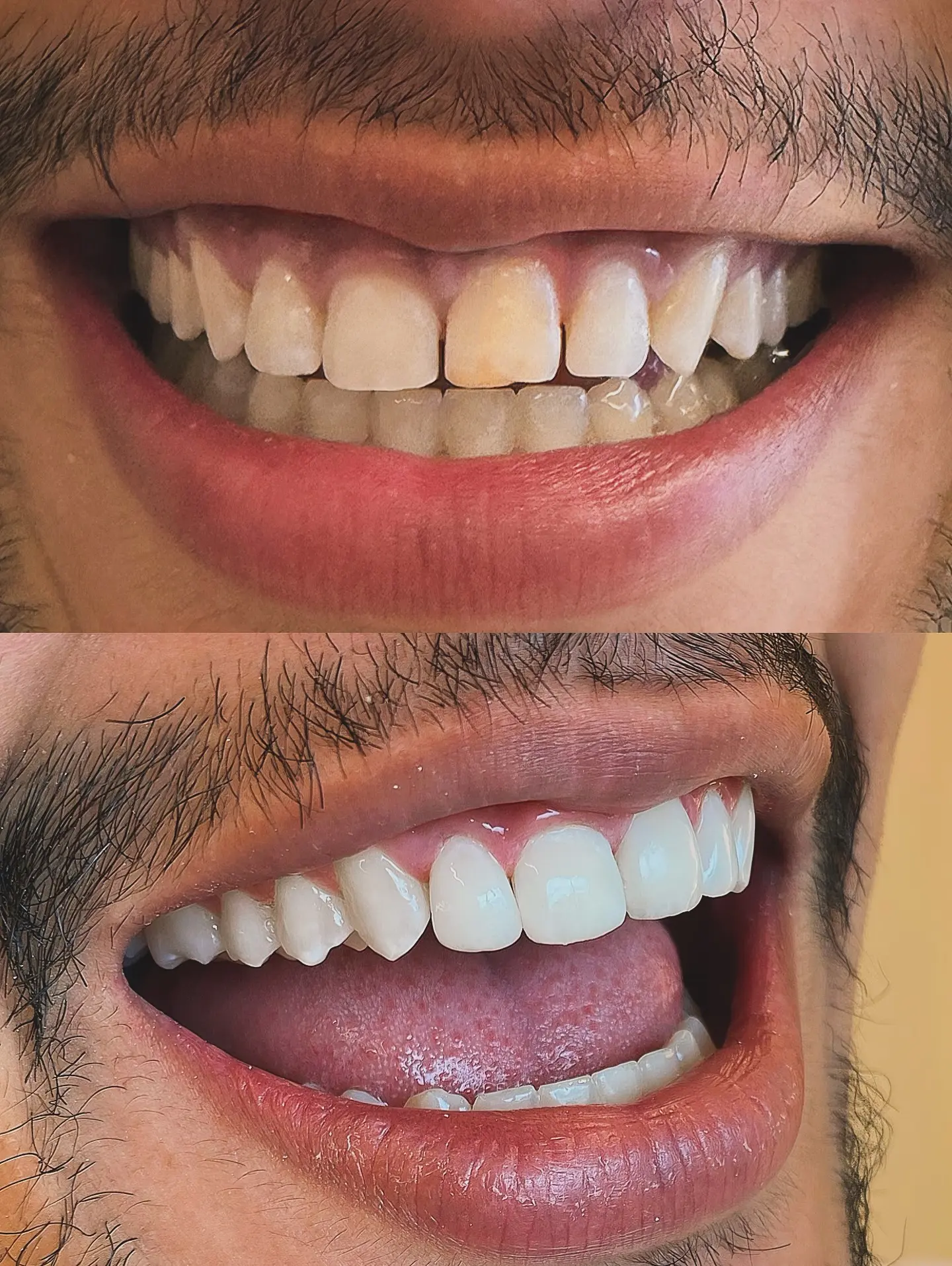 Resultado de facetas dentárias antes e depois