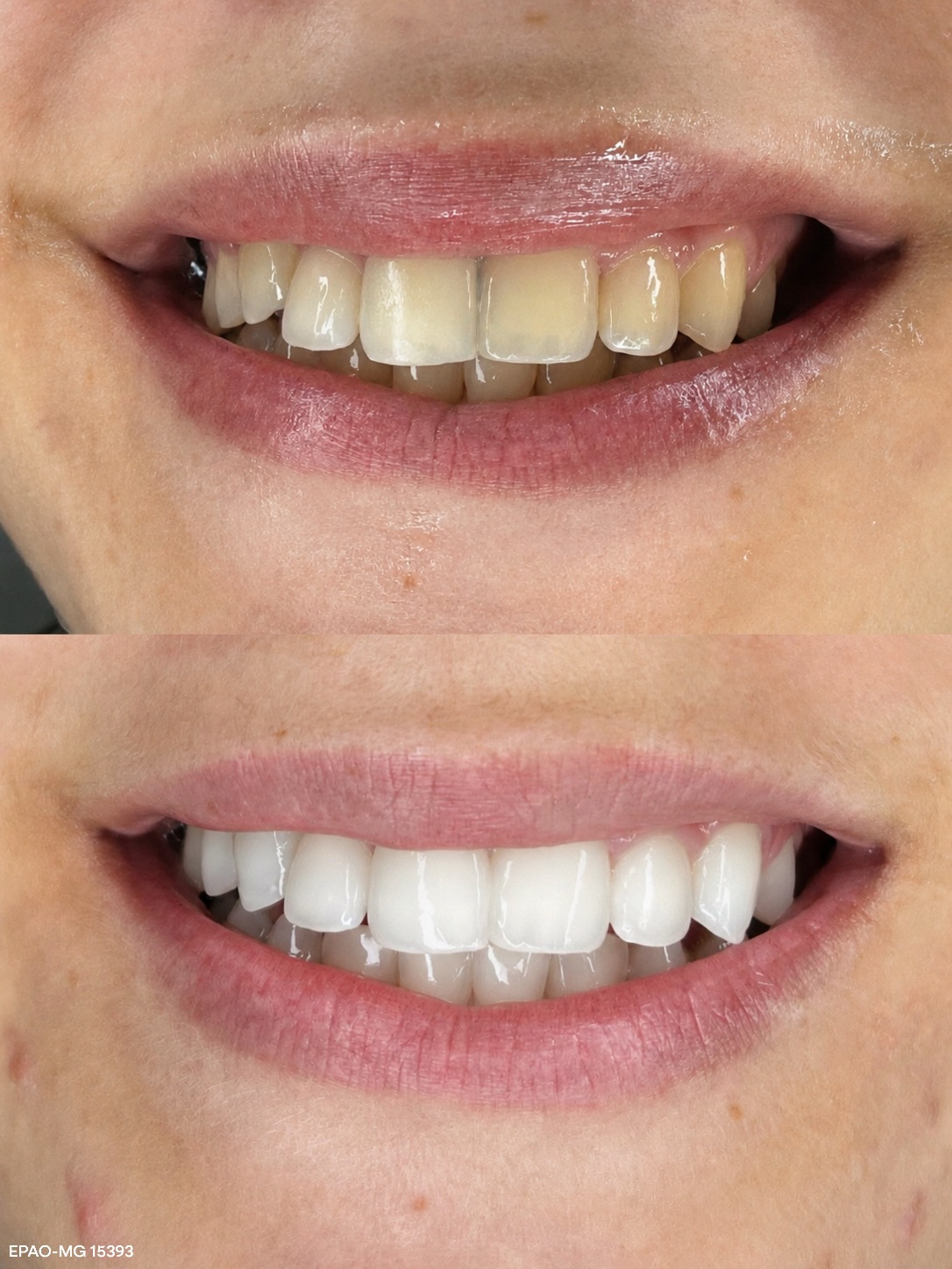 Resultado de clareamento dental antes e depois