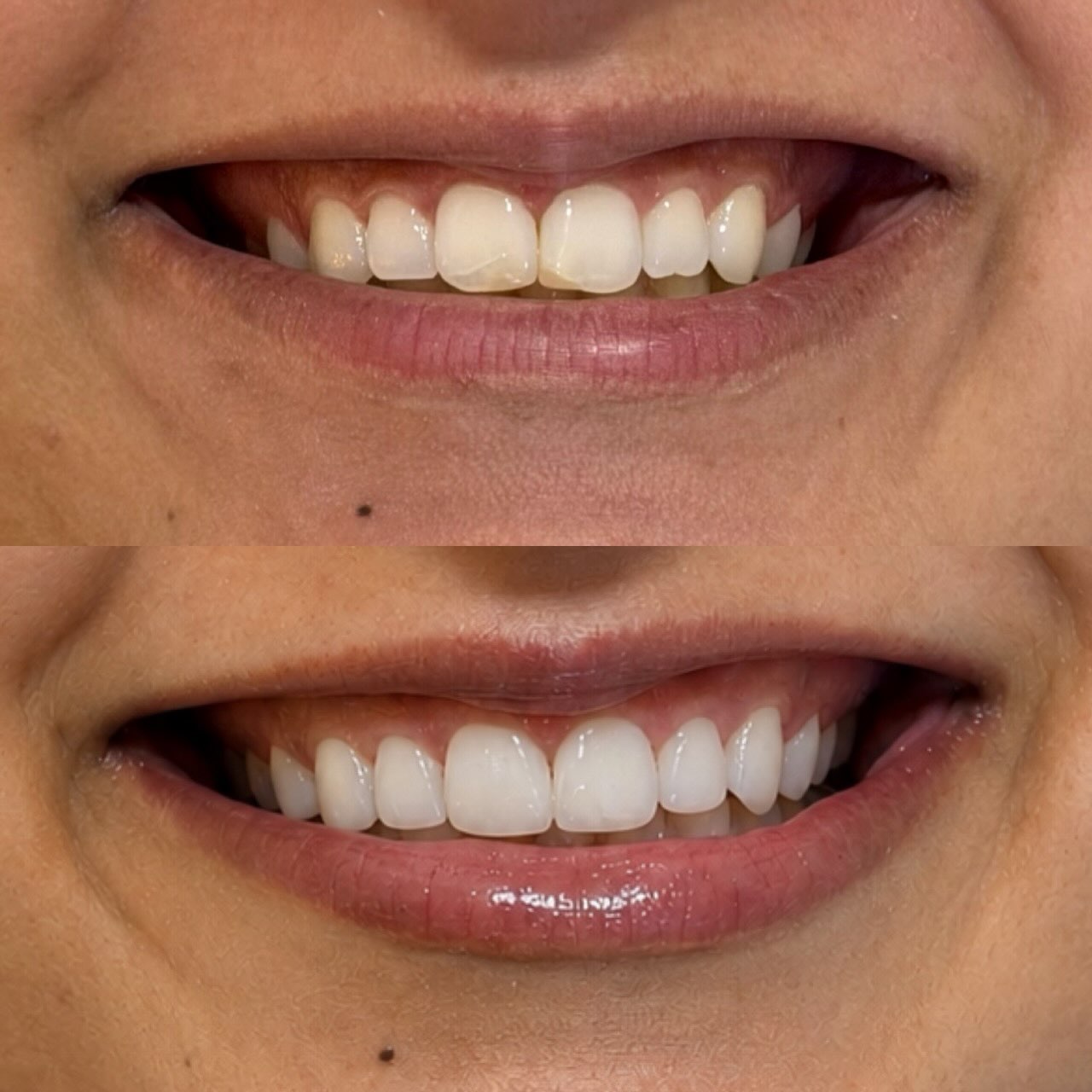 Resultado de tratamento estético antes e depois